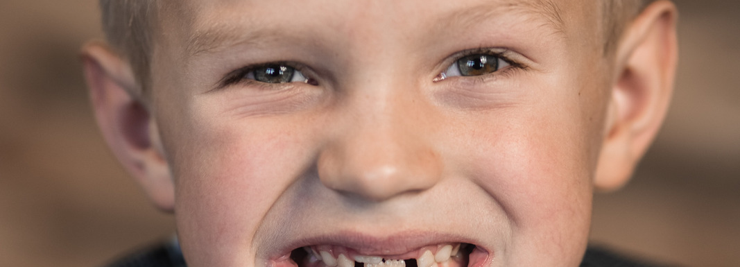 Kid smiling with missing teeth